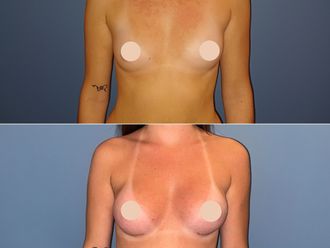 Augmentation mammaire avant et après - 878742
