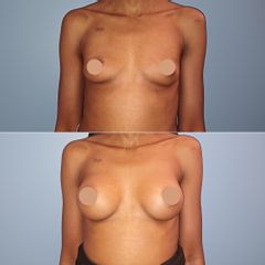 Augmentation mammaire avant après