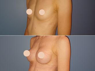 Augmentation mammaire avant et après - 878756
