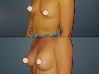 Augmentation mammaire avant et après - 880132