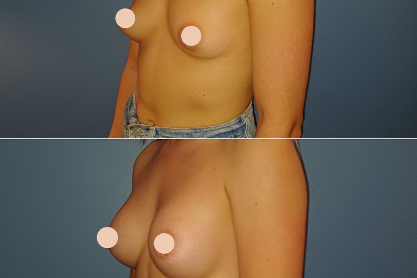 Augmentation mammaire avant et après - 880132
