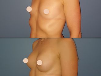 Augmentation mammaire avant et après - 880587