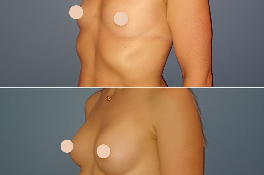 Augmentation mammaire avant et après - 880587