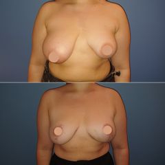 Mastopexie - Dr Samuel Struk
