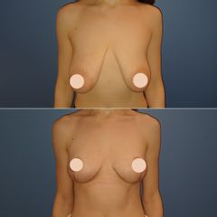 Mastopexie lifting mammaire - Dr Samuel Struk