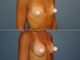 Augmentation mammaire avant et après - 881269
