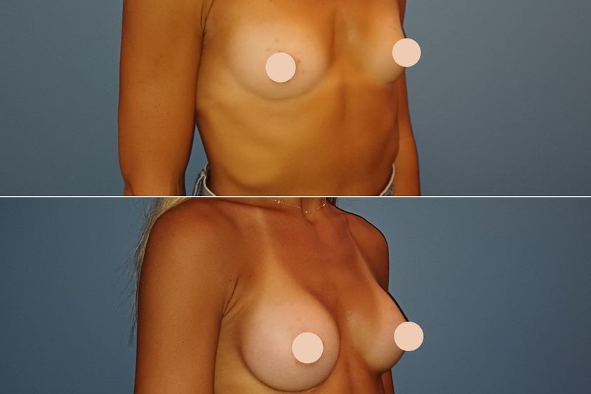 Augmentation mammaire avant et après - 881269