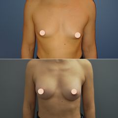 Avant après augmentation mammaire par prothèses vue de face
