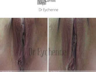 Vaginoplastie avant et après - 650309