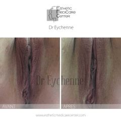 Avant après vaginoplastie