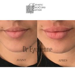 Augmentation des lèvres - Dr Catherine Eychenne