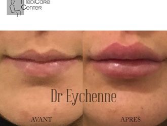 Augmentation des lèvres - 742500