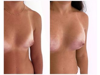 Implants mammaires-642326