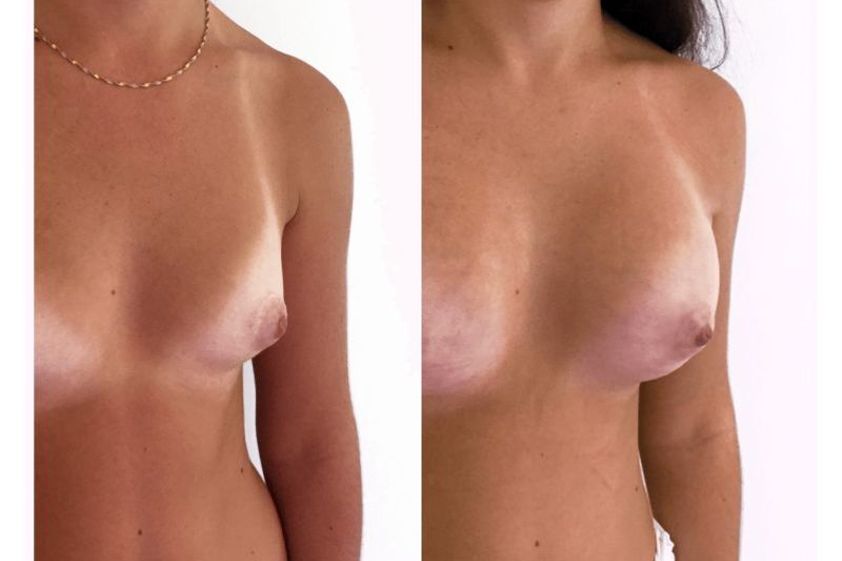 Implants mammaires avant et après - 642326