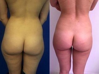 Avant après Liposuccion