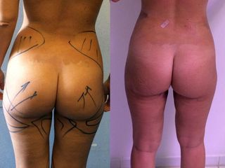 Avant après Liposuccion taille et fesses