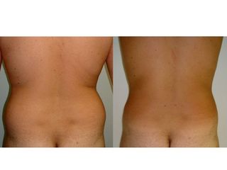 Avant après Liposuccion