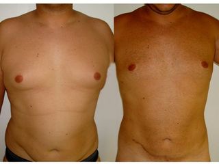 Avant après Liposuccion ventre et GYNECOMASTIES