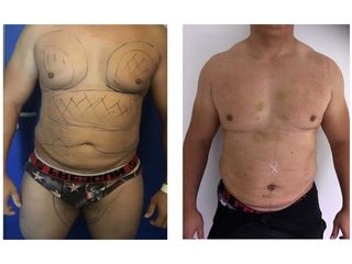 Avant après Liposuccion chez un HOMME