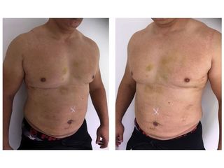 Liposuccion