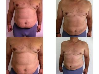 Avant après Liposuccion