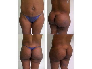 Avant après Liposuccion