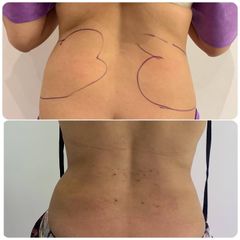 Liposuccion - Dr Maurice Félix