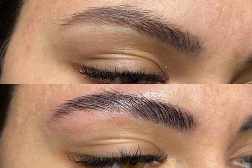 Dermopigmentation avant et après - 788070