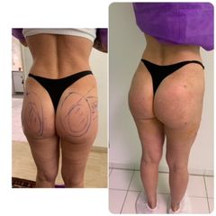 Augmentation des fesses par HYACORP Avant / Après Fesses