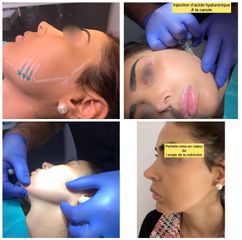 Jawline - Dr Maurice Félix