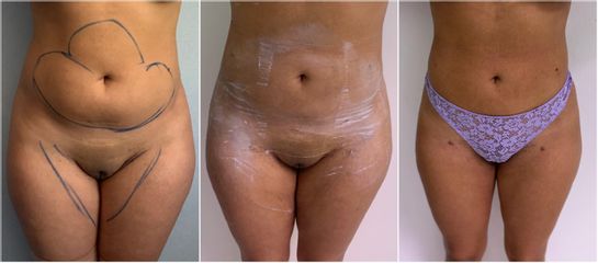Liposuccion - Dr Maurice Félix