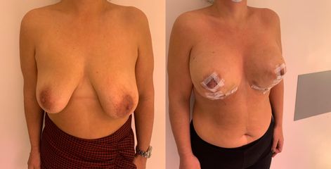 Lifting des seins - Dr Maurice Félix