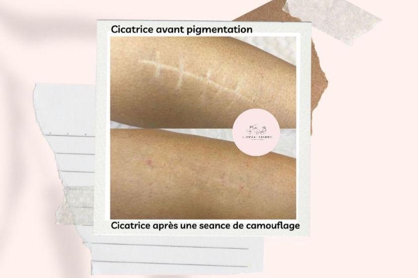 Dermopigmentation avant et après - 814140
