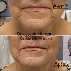 Acide hyaluronique - Dr Joseph Marciano