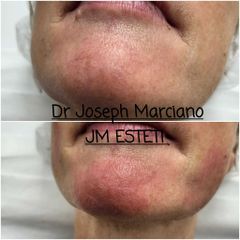 Acide hyaluronique - Dr Joseph Marciano