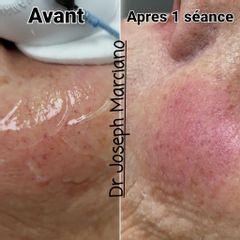 Acide hyaluronique - Dr Joseph Marciano