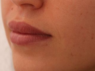 Augmentation des lèvres 