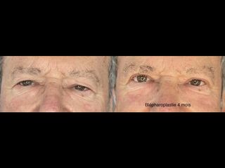 Blépharoplastie - Dr Thierry Van Hemelryck