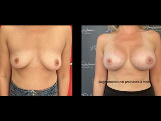 Augmentation mammaire - Dr Thierry Van Hemelryck