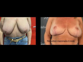 Réduction mammaire - Dr Thierry Van Hemelryck