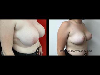 Réduction mammaire - Dr Thierry Van Hemelryck