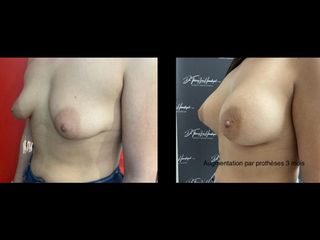 Augmentation mammaire - Dr Thierry Van Hemelryck