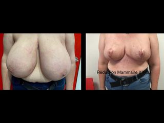 Réduction mammaire - Dr Thierry Van Hemelryck