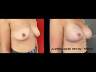 Augmentation mammaire - Dr Thierry Van Hemelryck