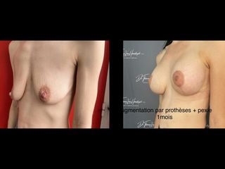 Augmentation mammaire - Dr Thierry Van Hemelryck