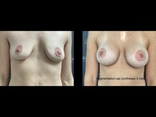 Augmentation mammaire - Dr Thierry Van Hemelryck