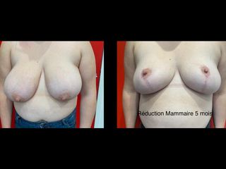 Réduction mammaire - Dr Thierry Van Hemelryck