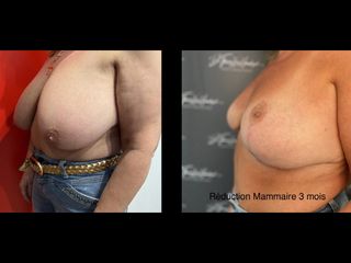 Réduction mammaire - Dr Thierry Van Hemelryck