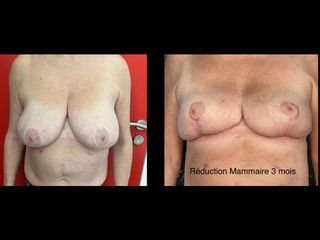 Réduction mammaire - Dr Thierry Van Hemelryck