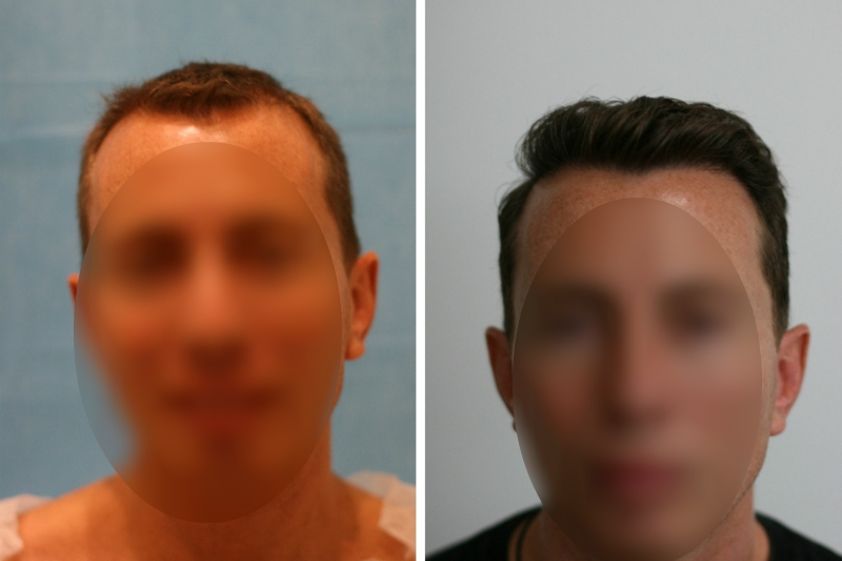 Greffe de cheveux avant et après - 633868